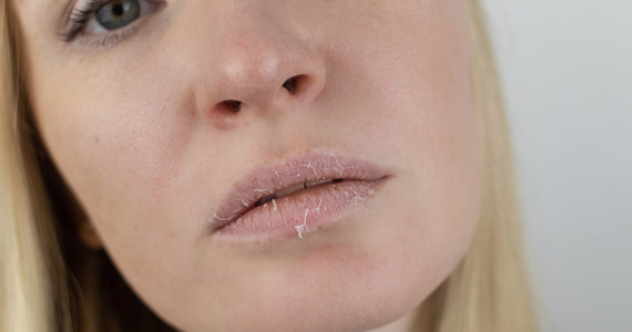 Jak walczyć z suchymi ustami?